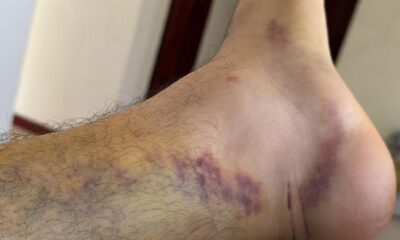 Policías Estatales le fracturaron a golpes un tobillo a ciudadano en Minatitlán