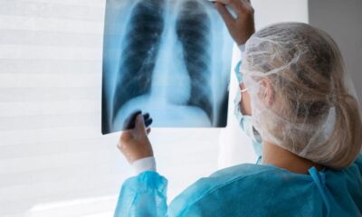 Orienta IMSS Veracruz Sur sobre síntomas de Tuberculosis