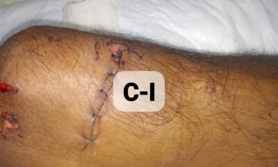 Afligida madre solicita apoyo para su hijo accidentado en moto; resultó con fractura de cadera