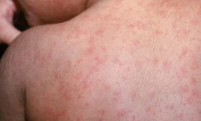 Secretaría de Salud emite aviso epidemiológico por sarampión