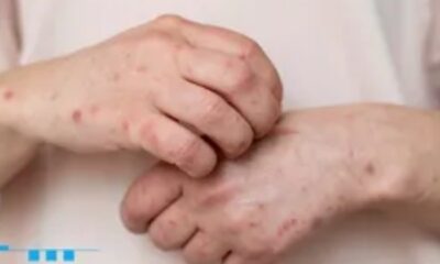 Menor rumano con sarampión contagió a tres personas en vuelo de AICM; uno es un bebé