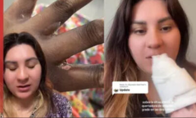 Mujer que afirma haber sido funcionaria de casilla acusa que sufrió quemadura por tinta indeleble