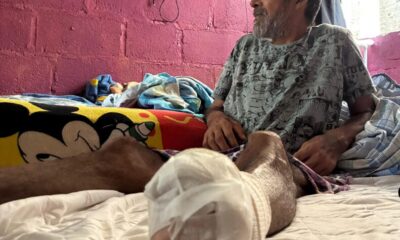 (+VÍDEO) La lucha silenciosa de Tomás: cuatro amputaciones y una batalla contra la diabetes en Minatitlán