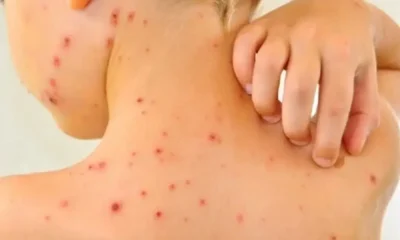 Mu3re bebé de 2 años por sarampión en Chihuahua: suman 5 muert3s en el país