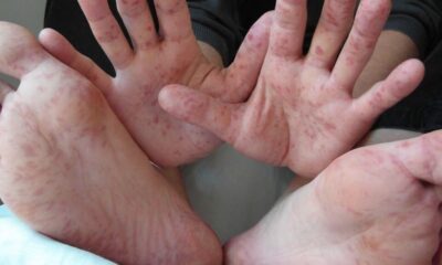 Brote de Coxsackie en escuela privada de Minatitlán: padres denuncian falta de acciones